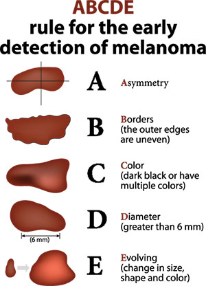 early melanoma detection