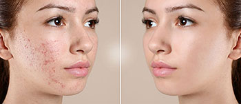 acne treatment before and after